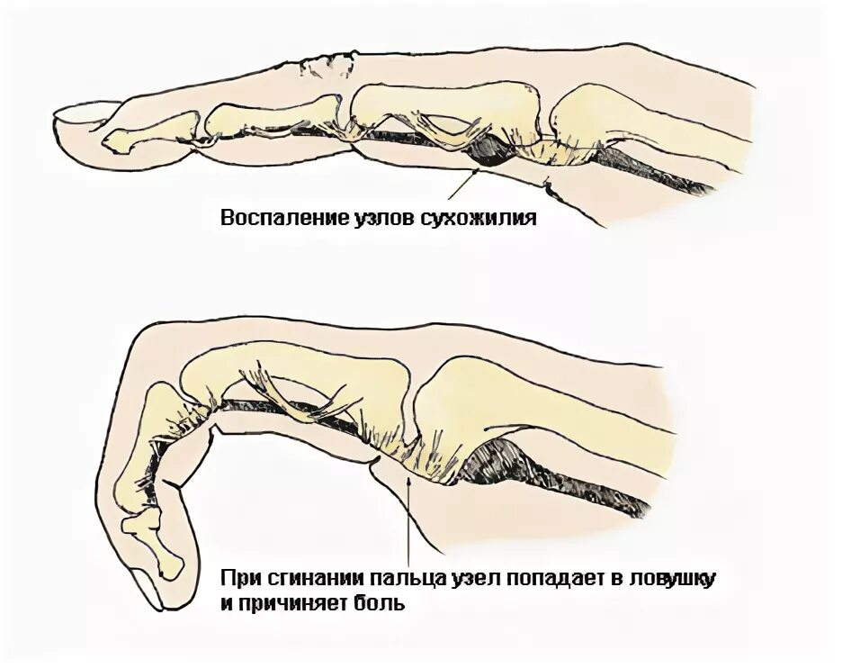 Болит большой палец на сгибе. Контрактура де Кервена. Болит сустав указательного пальца. Состав указательного пальца.