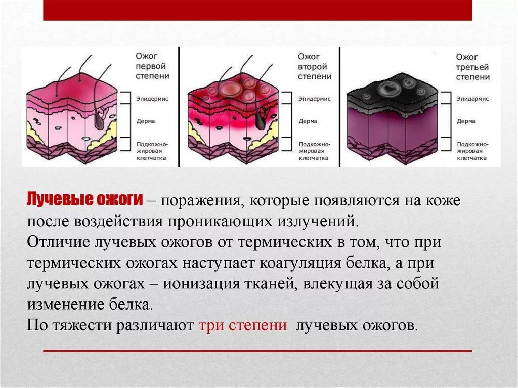 Радиационный ожог кожи.