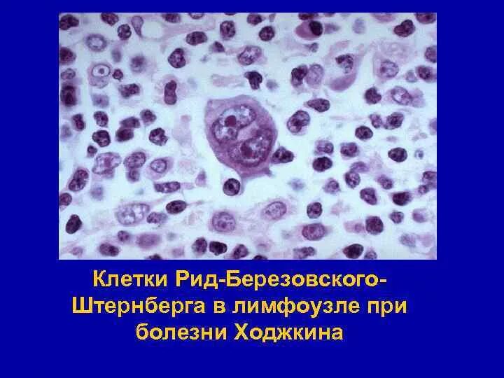 Клетки рид-березовского-штернберга. Морфология клеток рид-березовского-штернберга. Клетки березовского-штернберга гистология. Клетки рид-березовского-штернберга. Клетки рида – штернберга препарат.