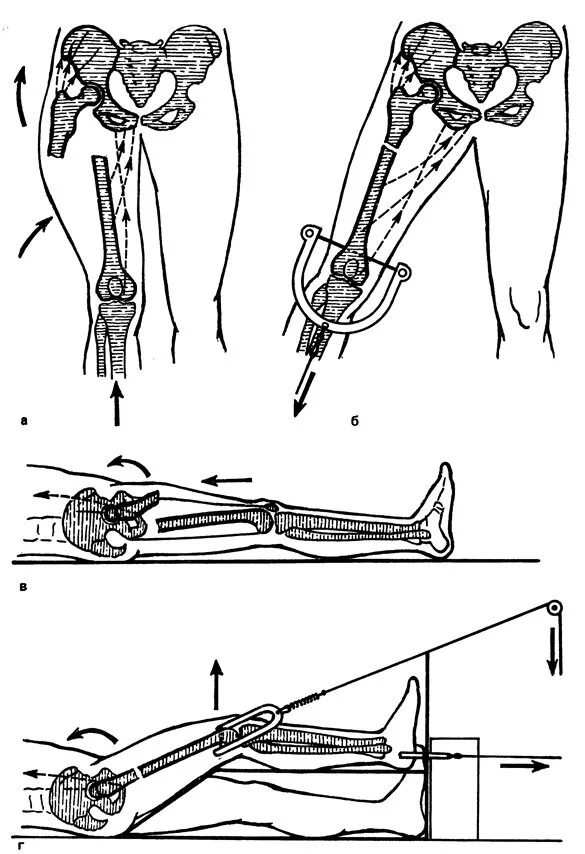 Перелом шейки бедра скелетное вытяжение. Скелетное вытяжение Беллера. Скелетное вытяжение через мыщелки бедра. Шина Беллера для скелетного вытяжения. Перелом бедра лечение без операции