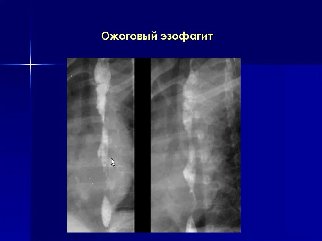 Диффузная пищевода. Стриктура пищевода рентген. Рубцовые стриктуры пищевода. Диффузное сужение пищевода рентген. Стеноз пищевода рентгенография.