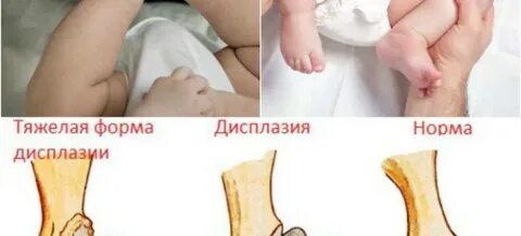 Дисплазия тазобедренных суставов у детей 3 месяца