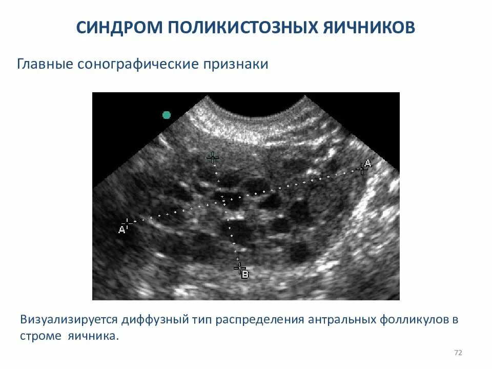 2 в яичниках образуются. Гиперплазия стромы яичника УЗИ. Фолликулы в яичниках норма УЗИ. Поликистоз яичников на УЗИ. УЗИ яичников доминантный фолликул.