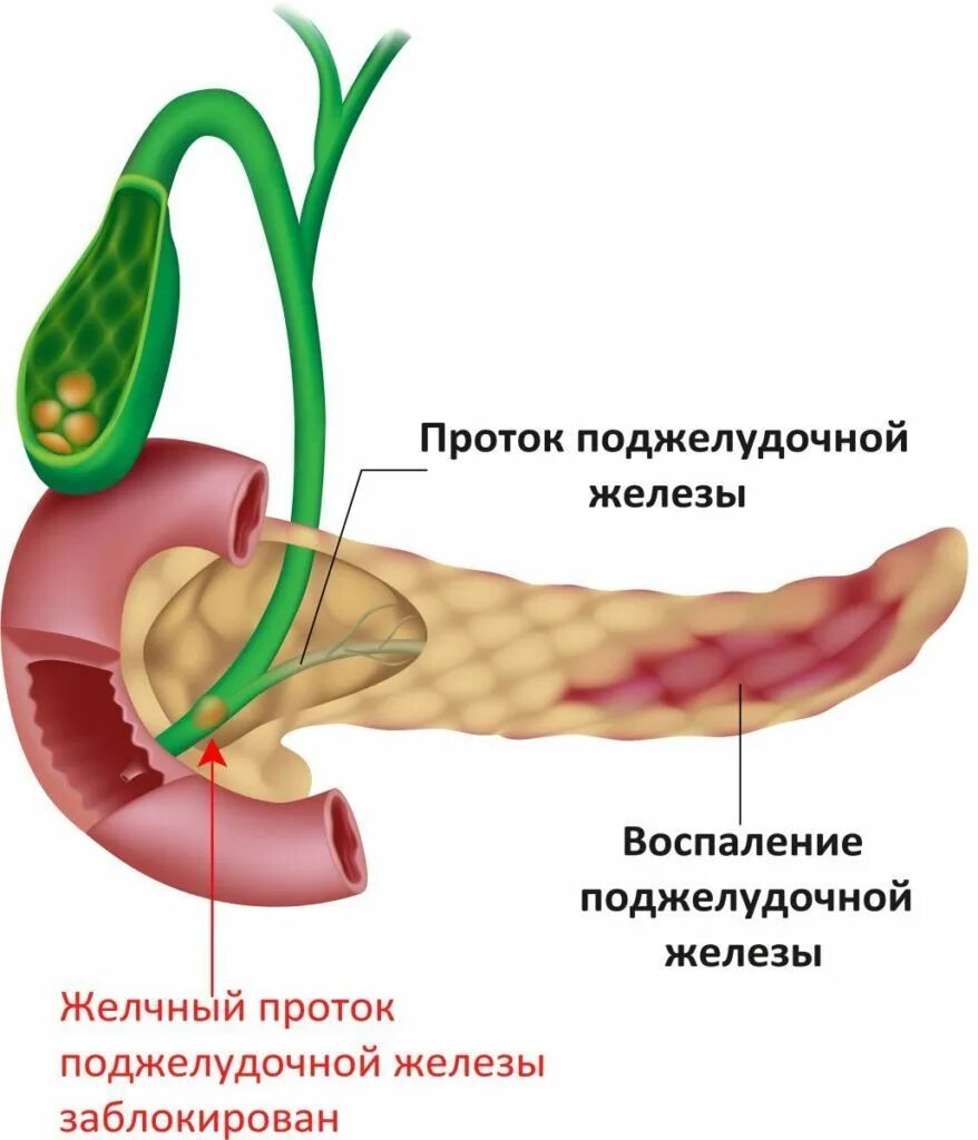 Причины боли в поджелудочной железе. Острый панкреатит поджелудочной железы. Хронический билиарный панкреатит. Хронический билиарнозависимый панкреатит. Желчный проток и проток поджелудочной.