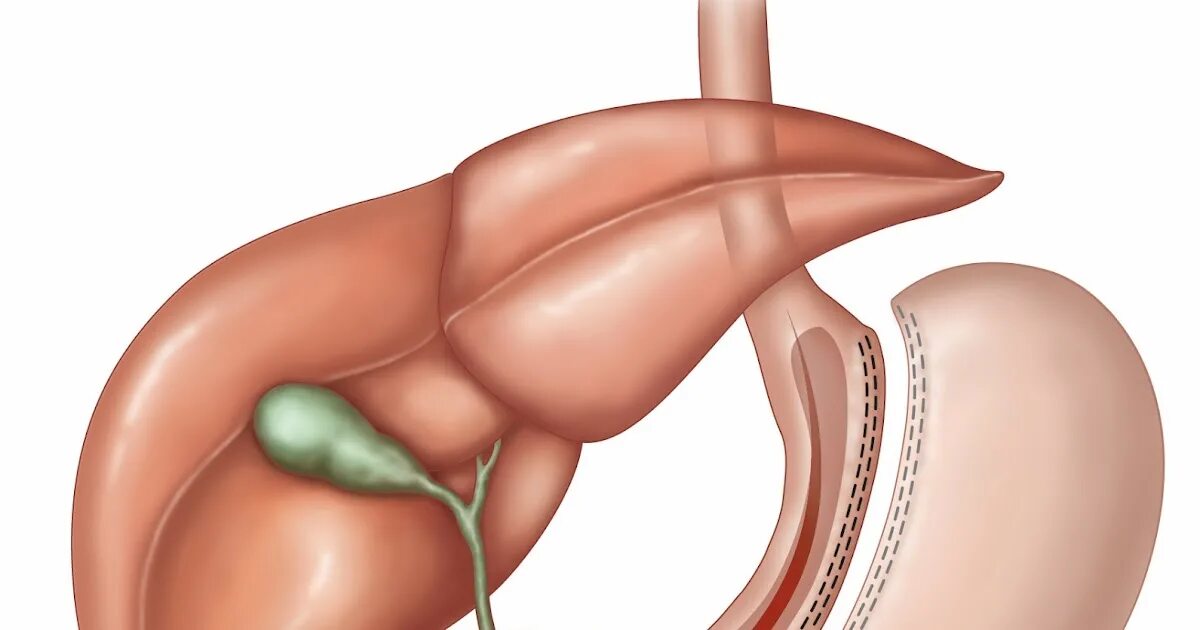 После удаления части желудка. Нерегулируемое бандажирование желудка. Бандажирование желудка шрам.