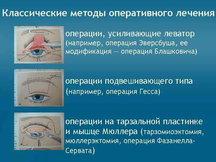 Хирургия птоза верхнего века. Операция при птозе верхнего века. Резекция леватора верхнего века. Птоз без операции