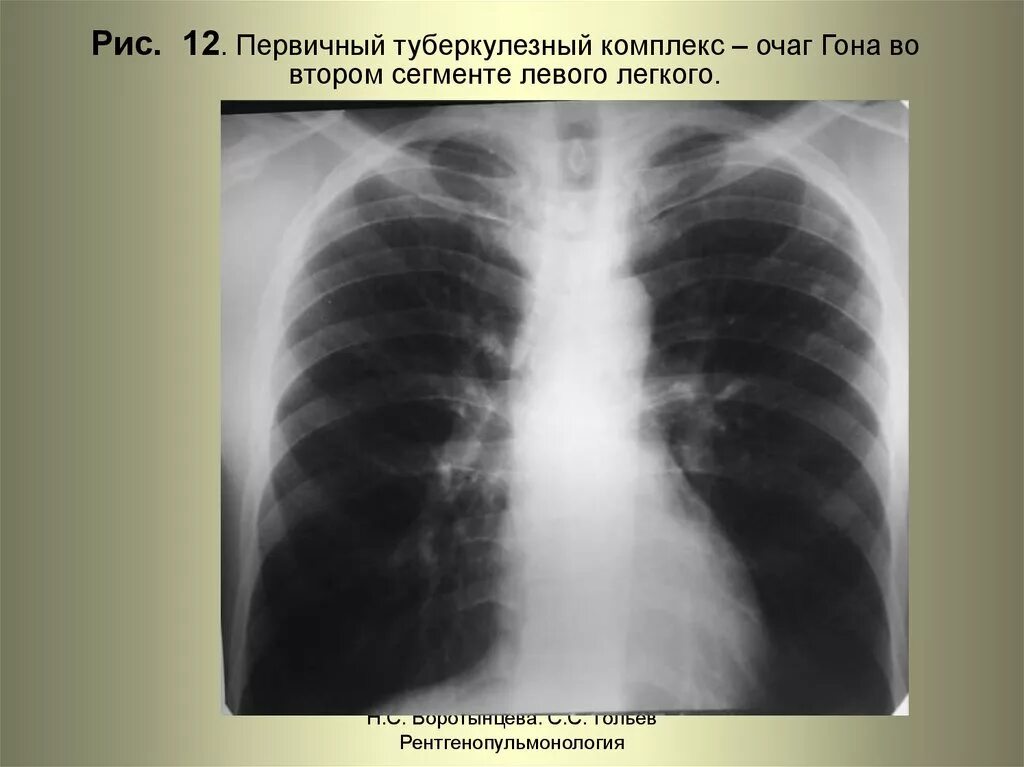 Очаги в сегментах легких
