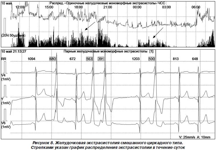 Одиночные мономорфные желудочковые экстрасистолы. Желудочковые экстрасистолы на Холтере норма. Мономорфная желудочковая экстрасистолия норма в сутки. Желудочковая экстрасистолия норма в сутки. Редкая одиночная мономорфная желудочковая экстрасистолия.