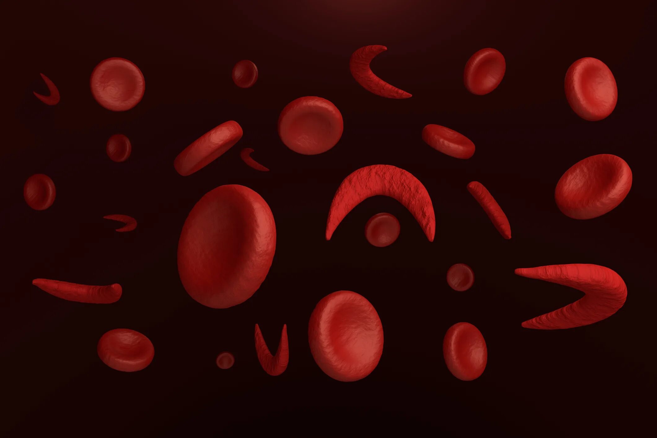 Анемия и эритроциты в крови. Серповидно клеточная анемия. Серповидноклеточная анемия эритроциты. Серповидно клетчатая анемия. Эритроциты при серповидноклеточной анемии.