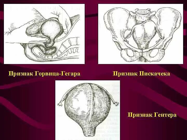 Признак пискачека. Симптомы Снегирева, Горвица - Гегара, Пискачека, Гентера. Признак Пискачека и Снегирева. Симптом Горвица Гегара Пискачека Гентера.