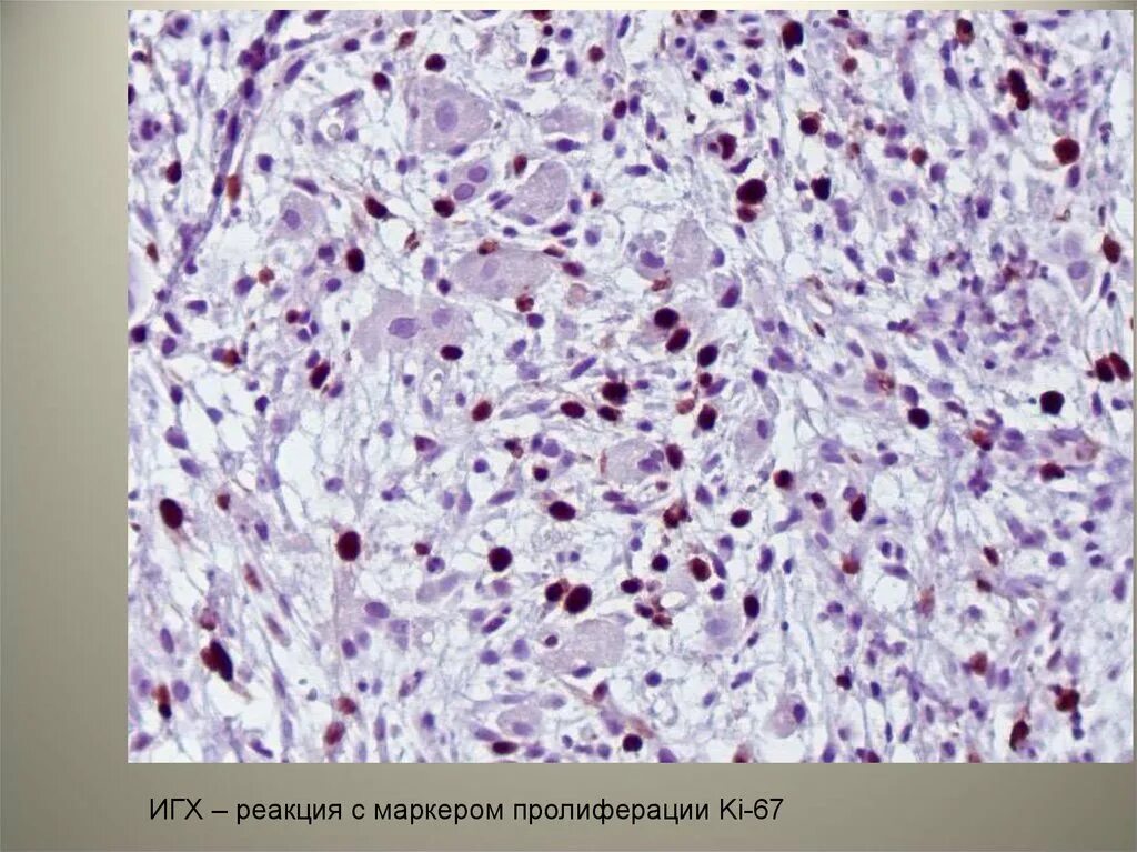 Иммуногистохимическое исследование ki-67. Маркеры пролиферации что это.