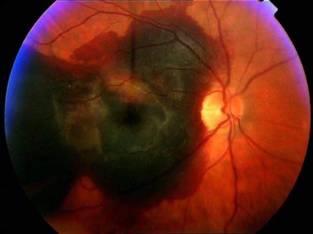 макула дистрофия сетчатки.