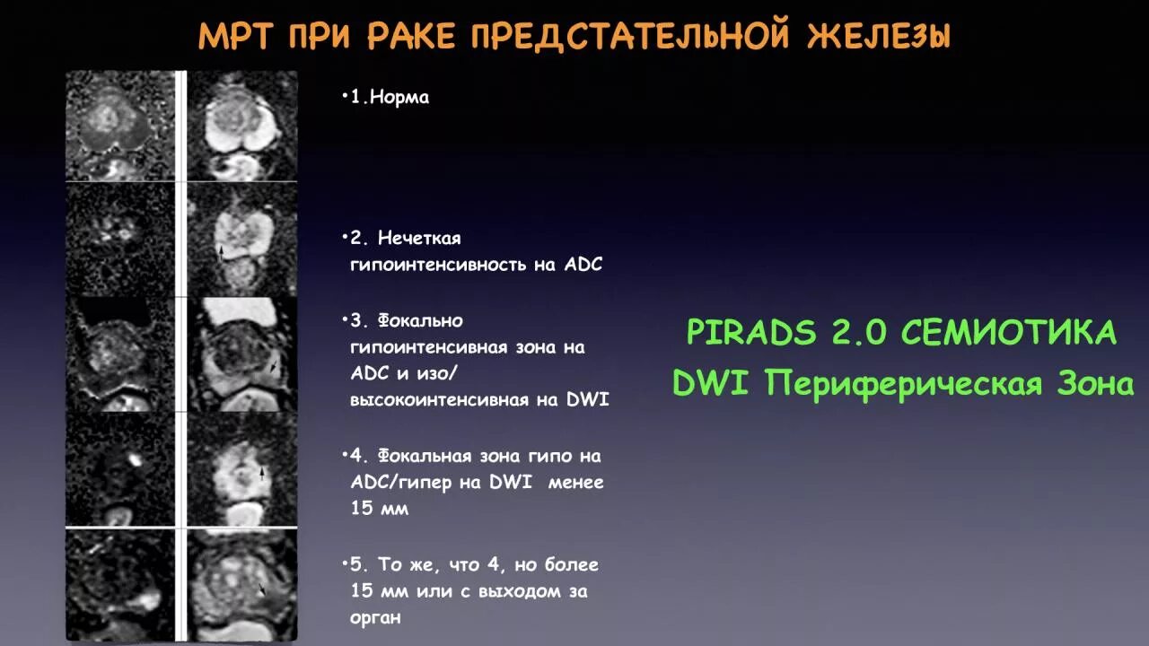 Предстательная железа pirads. Шкала Pirads мрт предстательной железы. Классификация предстательной железы мрт. Pi rads классификация для предстательной железы. Зоны предстательной железы мрт схема.