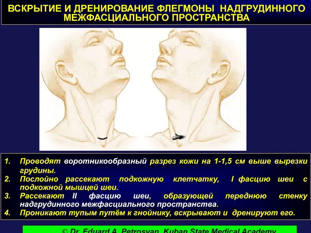 Флегмона надгрудинного межапоневротического пространства. Вскрытие флегмоны надгрудинного межапоневротического пространства. Вскрытие и дренирование абсцесса. Разрезы при флегмонах и абсцессах шеи.