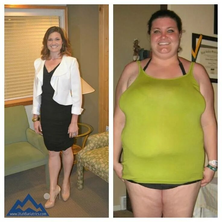 После операции можно похудеть. Абдоминопластика с липосакцией. Якорная абдоминопластика. Красивое похудение до и после. После операции можно похудеть.