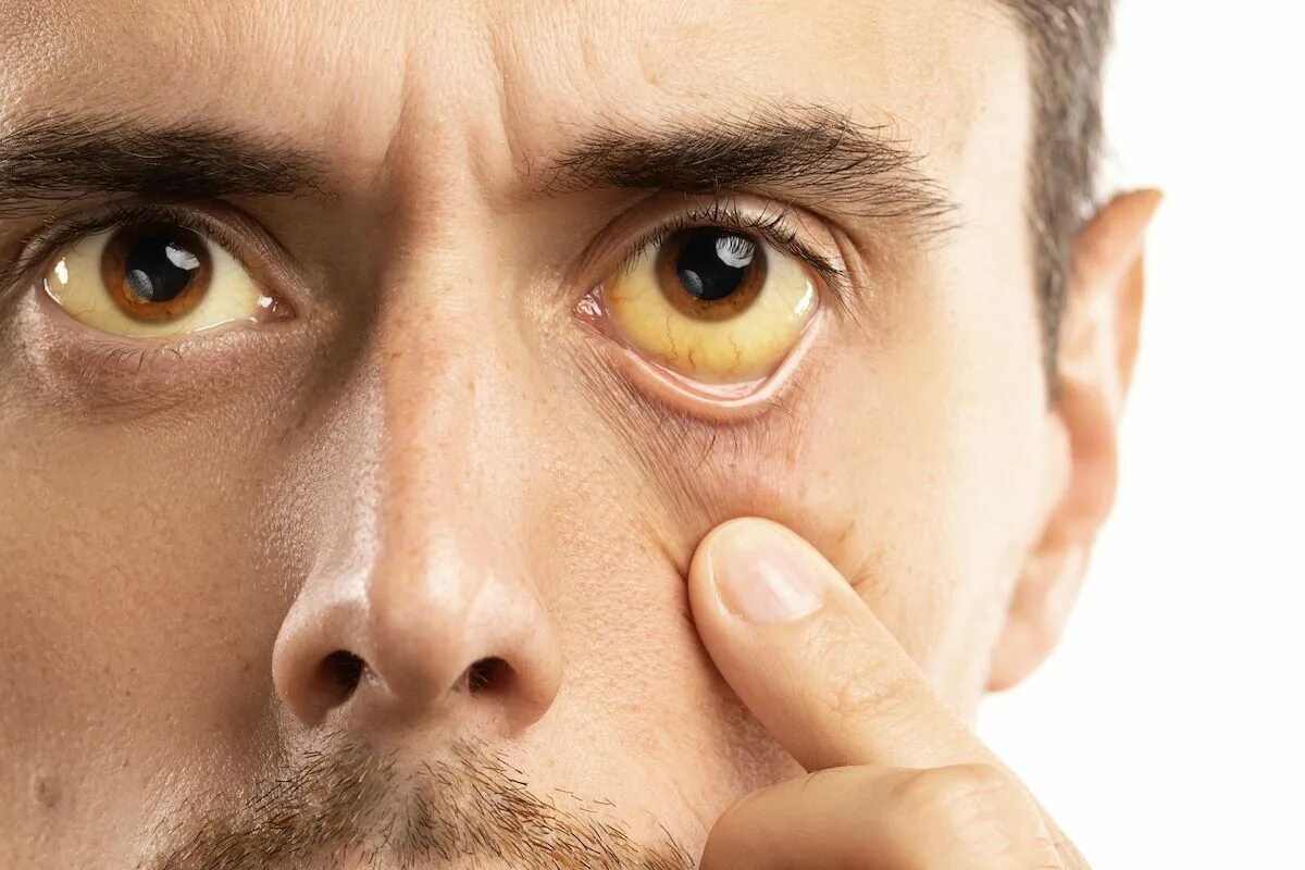 Желтые белки синдром Жильбера. Жёлтые глаза у человека. Субиктеричность склер.