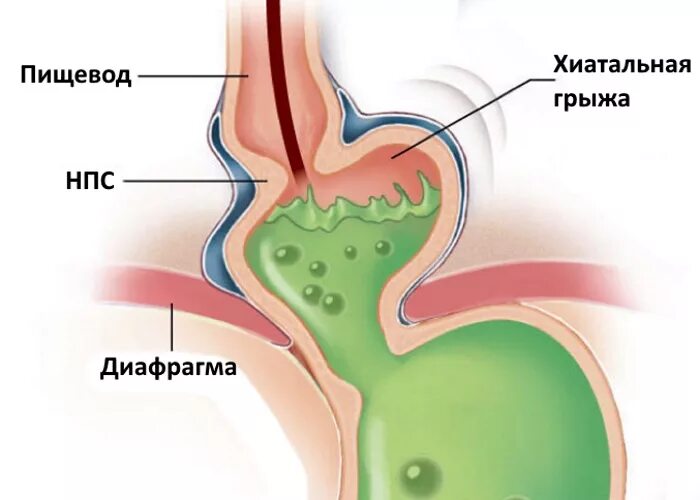 Изжога в горле пищеводе. Хиатальное отверстие диафрагмы. Аксиальная хиатальная грыжа степени. Аксиальная хиатальная грыжа 2 степени что это такое. Хиатальная грыжа желудка что это.