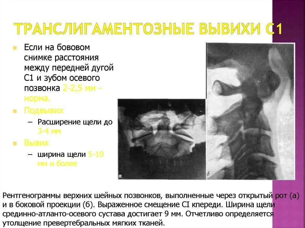Подвывих по ковачу. Вывих атланто-осевого сустава рентген. транслигаментозный подвывих атланта. анатомия атланто аксиального сочленения рентген. ротационный подвывих атланта с1.
