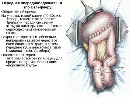 Операция желудка кишечника