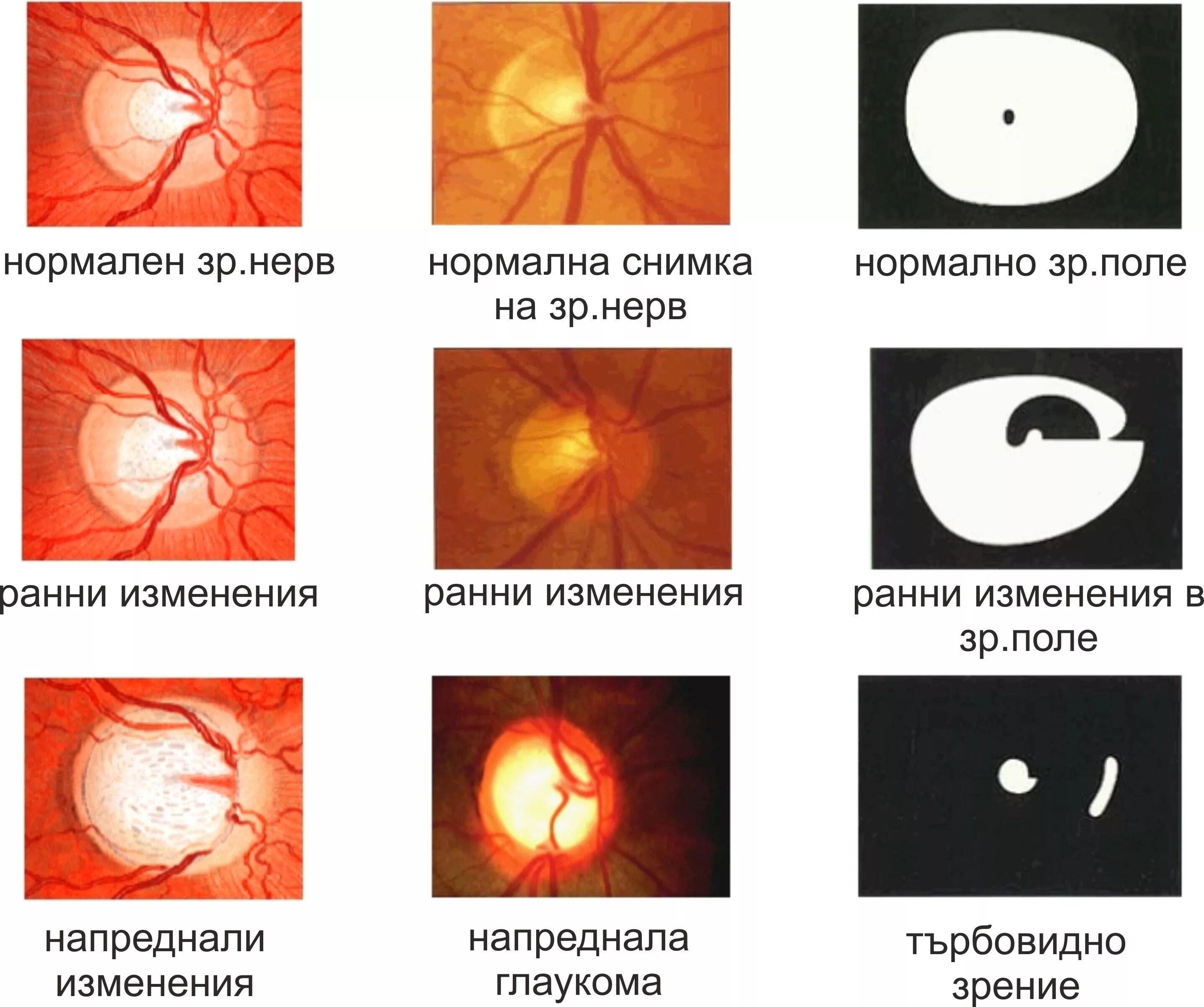 Глаукома поля зрения. Стадии глаукомы. Вернуть зрение при глаукоме