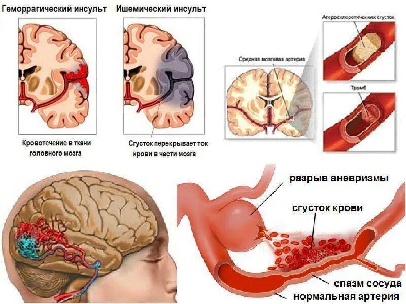 Что такое ишемический инсульт головного мозга. ОНМК геморрагический инсульт. Осложнения ОНМК ишемический инсульт. Инсульт картинки. Геморрагический инсульт этиология.