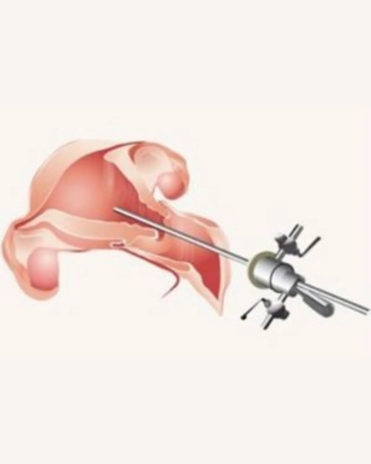 Гистероскопия гистерорезектоскоп. Гистерорезектоскопия миомы. Гистерорезектоскопия полипа эндометрия. Гистероскопия операция удаления полипа