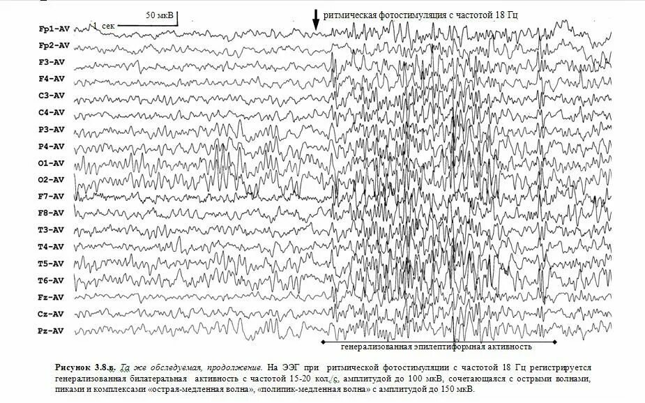 Спайк волновая активность на ЭЭГ. ЭЭГ эпилепсия пик-волна. Полипик волна на ЭЭГ. Острые волны на ЭЭГ. Спайк на ээг