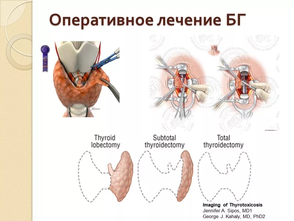 Сколько длится операция щитовидной. Гемитиреоидэктомия щитовидной железы схема. Тиреоидэктомия щитовидной железы ДТЗ. Зоб щитовидной железы операция. Классификация операций на щитовидной железе.