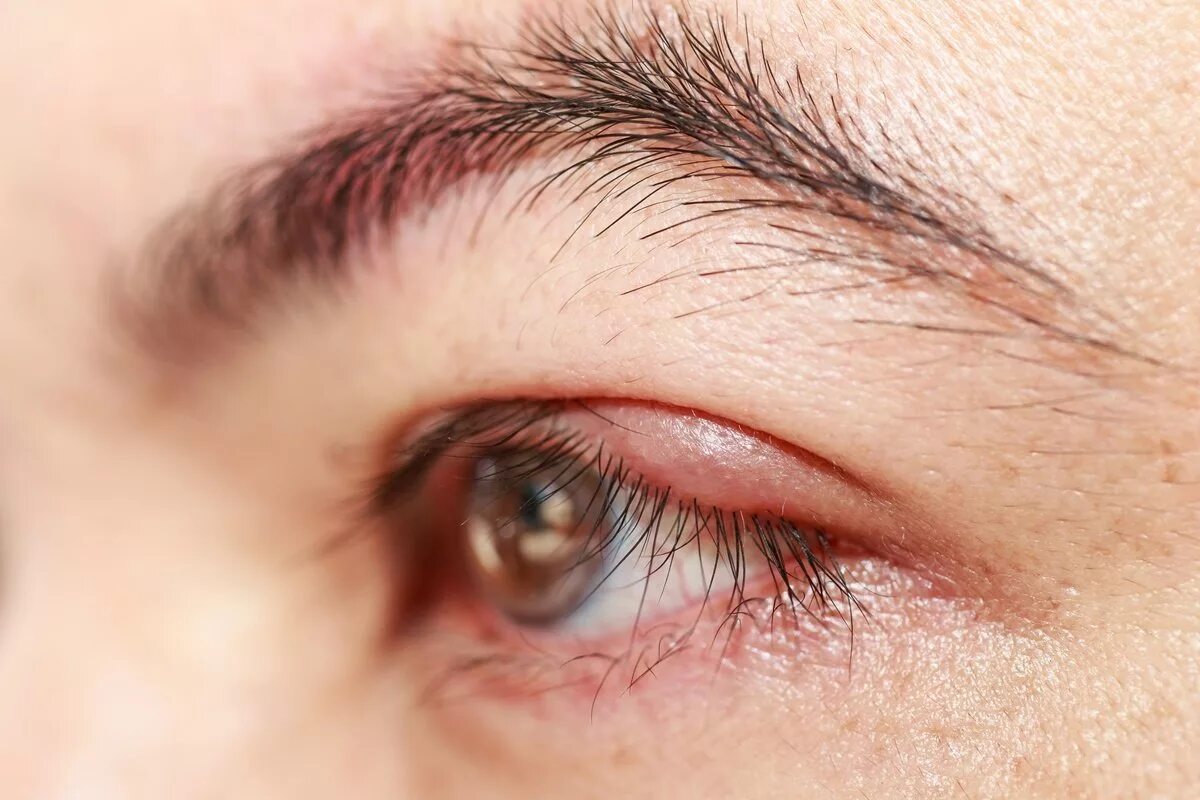 Болят глаза причины лечение. Блефарит демодекозный глаза.