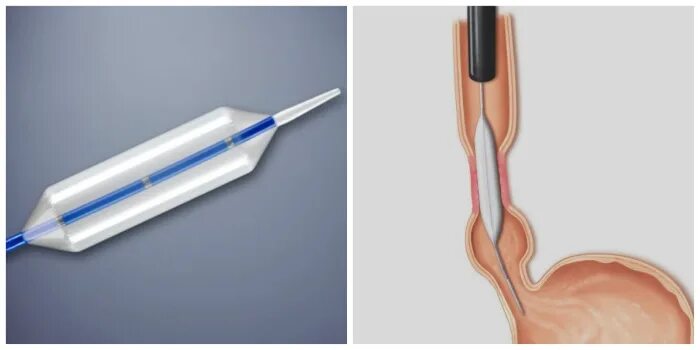 Пищевод шацкого. Стеноз пищевода бужирование. Баллонная кардиодилатация ахалазия. Эндоскопическая баллонная дилатация. Баллонное бужирование.