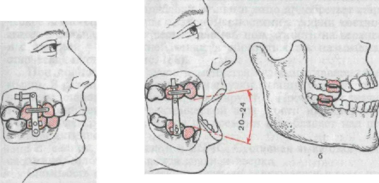 Почему не открывается рот. Аппарат для сустава нижней челюсти Петросова. Аппарат Петросова для ВНЧС.