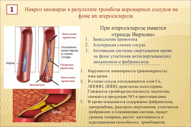 Острый тромбоз коронарных артерий. Тромбоэмболии коронарного сосуда. Атеросклероз коронарных артерий сосуды. Триада Вирхова атеросклероз. Возникновение тромбов