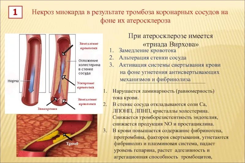 Изменение сосудистой стенки. Острый тромбоз коронарных артерий. Тромбоэмболии коронарного сосуда. Атеросклероз коронарных артерий сосуды. Триада Вирхова атеросклероз.