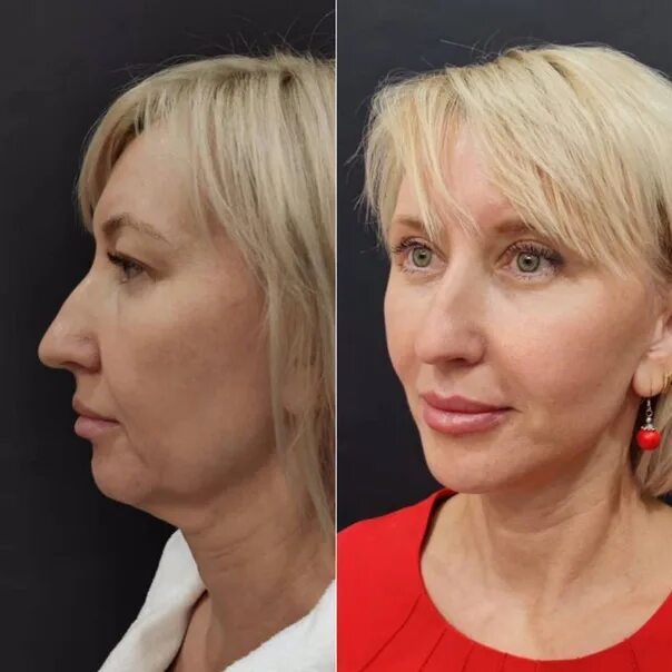 Классическая SMAS подтяжка 2/3 лица и шеи Dr. Tkachenko_K