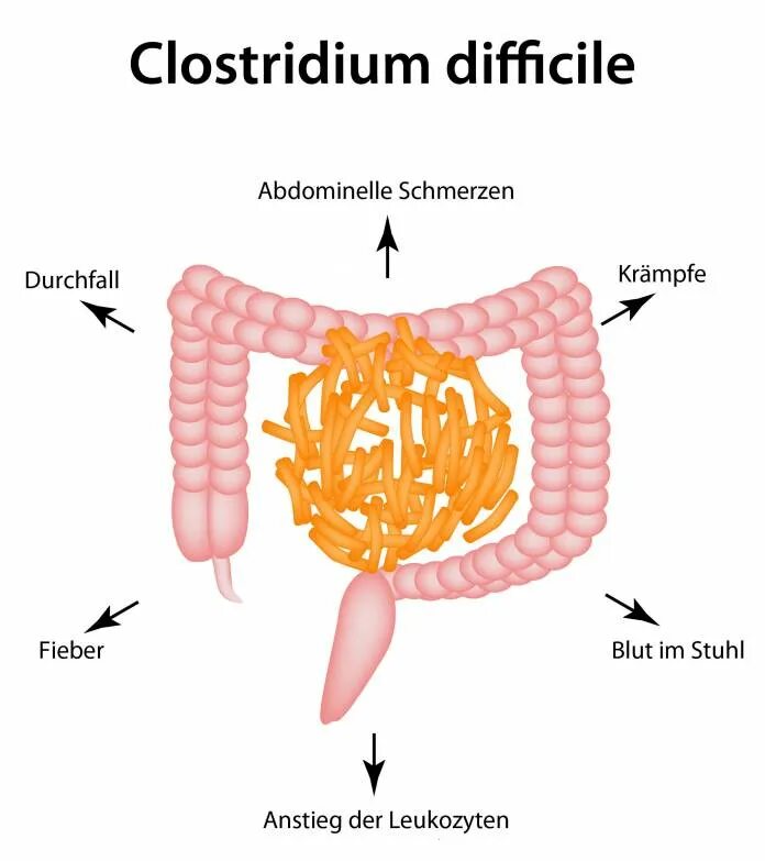 Токсин клостридии диффициле. Эпидемиология клостридии диффициле. Clostridium oedematiens патогенез.