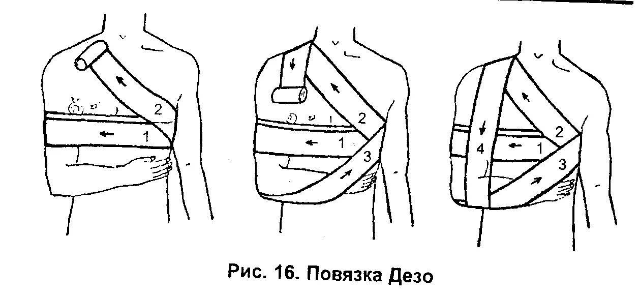 Плечевая повязка алгоритм. Наложение повязки Дезо алгоритм. Повязка Дезо алгоритм. Наложение бинтовых повязок на туловище: Дезо при переломе ключицы. Алгоритм повязка Дезо алгоритм.