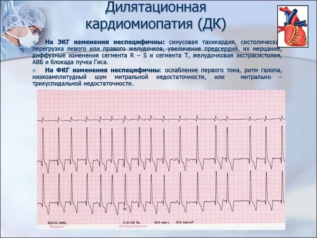 ЭКГ при дилатационная кардиомиопатия. Синусовая тахикардия кардиограмма. Рестриктивная кардиомиопатия ЭКГ. Синусовая тахикардия на ЭКГ. Перегрузка на экг что это