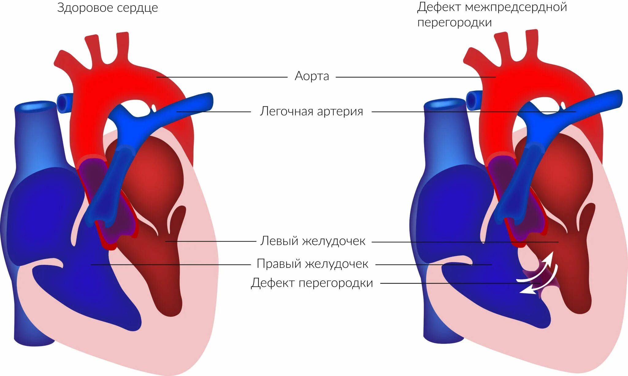 Порок сердца дмпп. Врожденный порок сердца дмпп. порок сердца дефект межпредсердной перегородки. впс-дмпп- дефект межпредсердной перегородки. врождённый порок сердца межпредсердной перегородки.