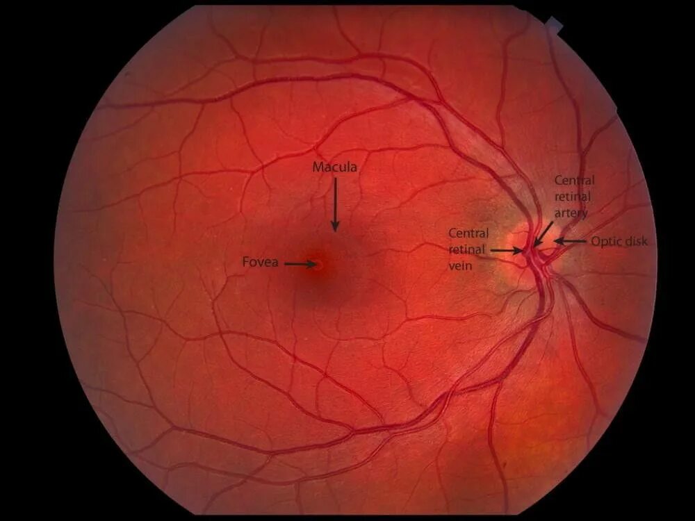 Макула и фовеа. Папиллит (оптический неврит). Неврит зрительного нерва. H46 неврит зрительного нерва.. Центр сетчатки