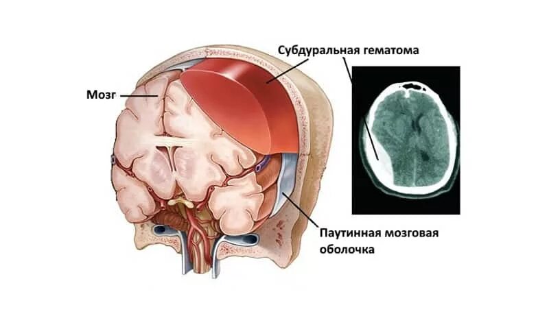 Черепно-мозговая гематома субдуральная. Субдуральная гематома черепа. Сдавление мозга субдуральгная гематомы. Гематома субдуральная травматическая. Гематома мозга операция