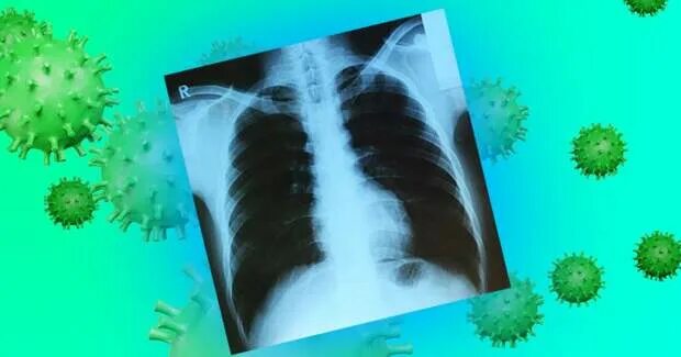 Как выглядят легкие после ковид Artificial intelligence can calculate someone's risk of dying from COVID-19 scan
