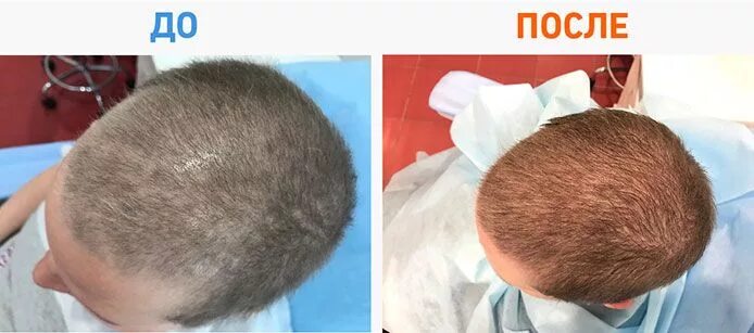 Волосы на голове после химиотерапии. Алопеция после химиотерапии. После химиотерапии волосы растут. Выпадение волос после химии терапии.