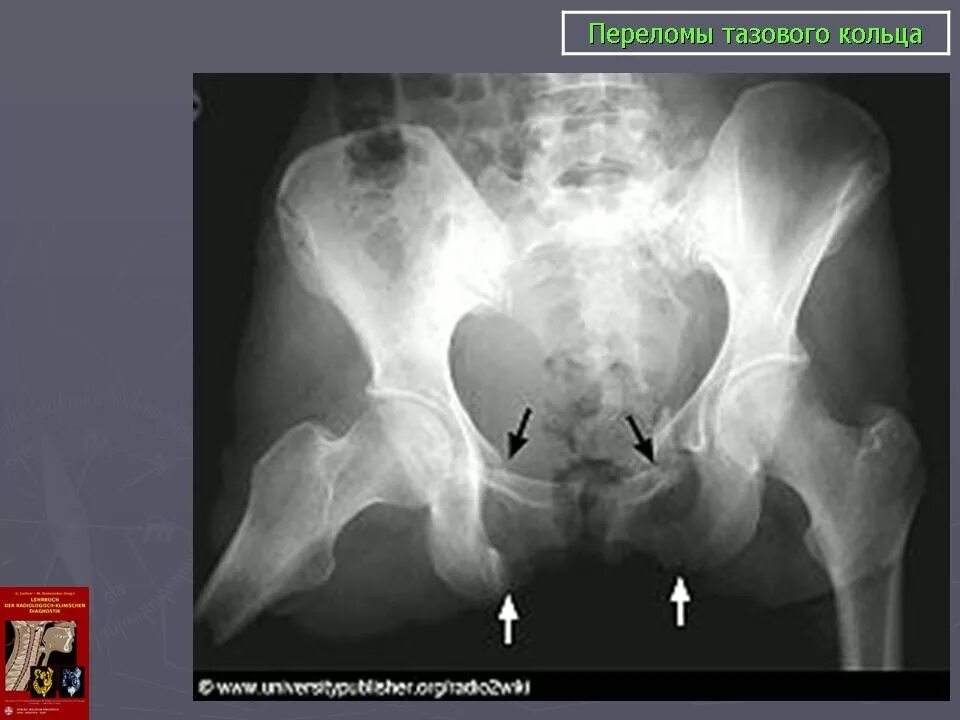 Перелом лобковой кости таза рентген. Перелом лонной кости рентген. Переломы костей тазового кольца с нарушением его непрерывности. Перелом таза лонной кости рентген.