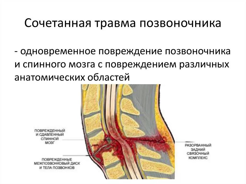 Сочетанные повреждения позвоночника. Позвоночно-спинномозговая травма. Сочетанные и комбинированные травмы. Осложнения перелома позвоночника