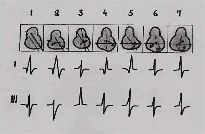 Поворот сердца правым желудочком вперед что это. Поворот верхушкой кзади на ЭКГ. Поворот сердца верхушкой кзади на ЭКГ. Поворот сердца вокруг поперечной оси. Повороты сердца вокруг оси на ЭКГ.