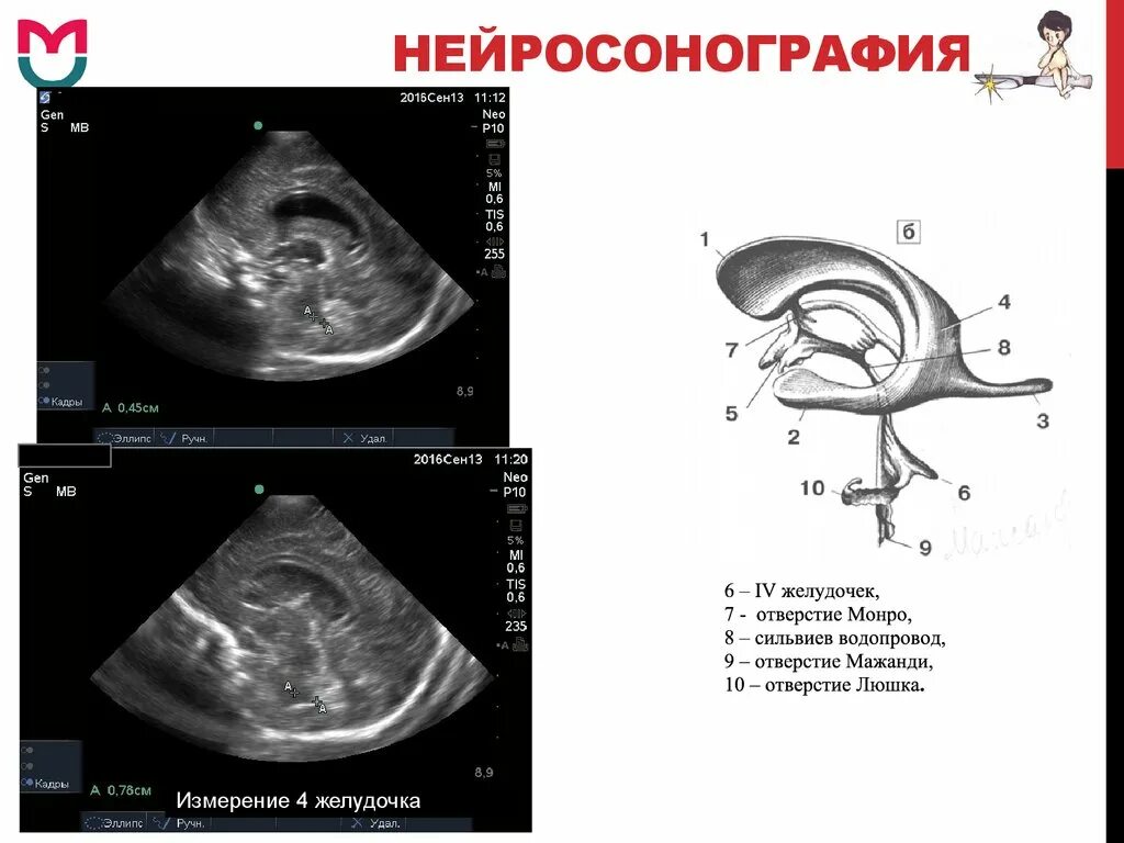 Нейросонография новорожденных нормы 3 месяца. Третий желудочек нейросонография. Нейросонография Сагиттальный срез. Нейросонография 4 желудочек. Расширение желудочков у новорожденного