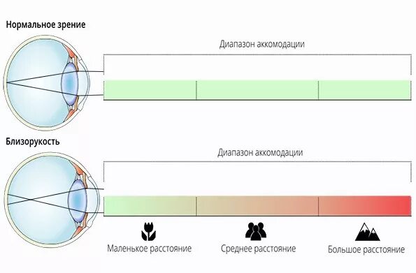 Заболевания аккомодации. Нарушение аккомодации. Нарушение аккомодации глаза. Диапазон аккомодации глаза. Ослабление аккомодации.