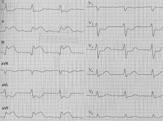 Инфаркт миокарда нижней стенки лж. Заднедиафрагмальный инфаркт миокарда ЭКГ. Заднебазальный инфаркт миокарда ЭКГ. V4-v6 ЭКГ стенка. Очаговые изменения желудочка