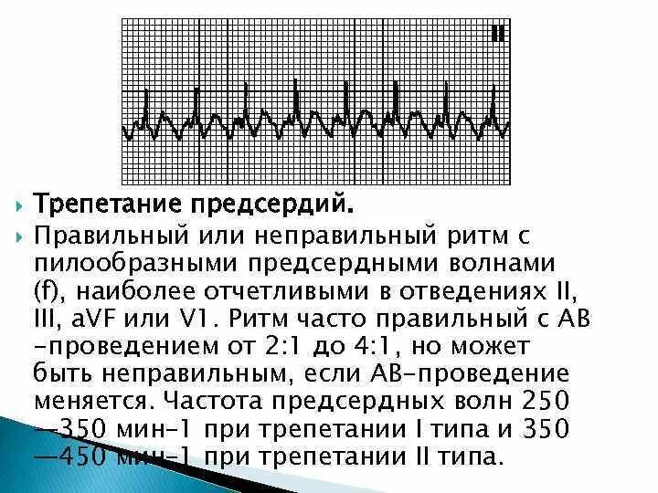 Трепетание предсердий 1 к 1 на ЭКГ. Трепетание предсердий по ЭКГ. Предсердный ритм на ЭКГ. Трепетание предсердий 2 к 1 на ЭКГ. Формы трепетания предсердий