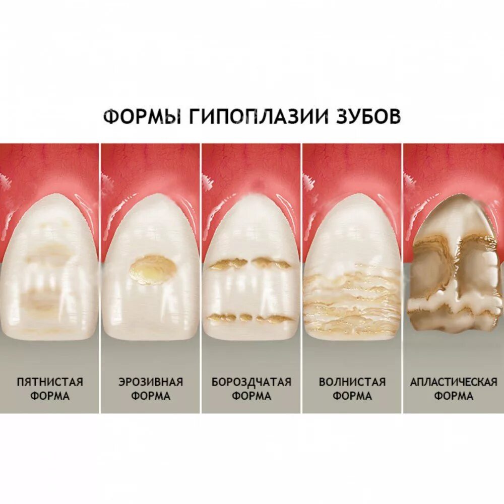 Полые зубы